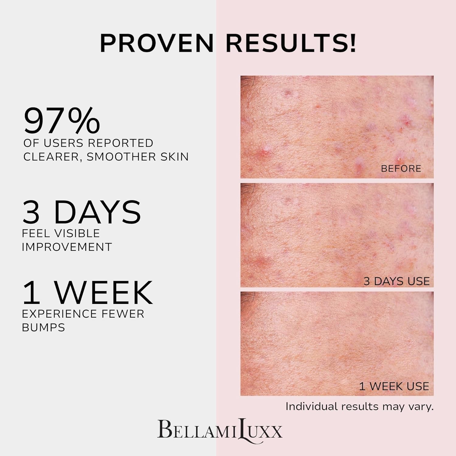 Bellamiluxx Butt Acne Clearing Treatment Cream: Body Acne Treatment for Folliculitis and Pimples on Buttocks, Thighs, and Body with 2% Salicylic Acid & Tea Tree Oil - Butt Cream for Smooth Skin
