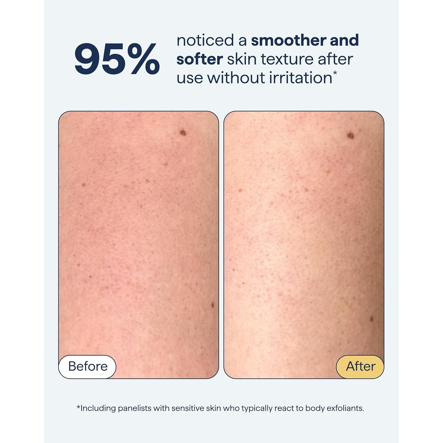 Remedy KP Exfoliating Body Scrub | Keratosis Pilaris and Chicken Skin Treatment - 200ml