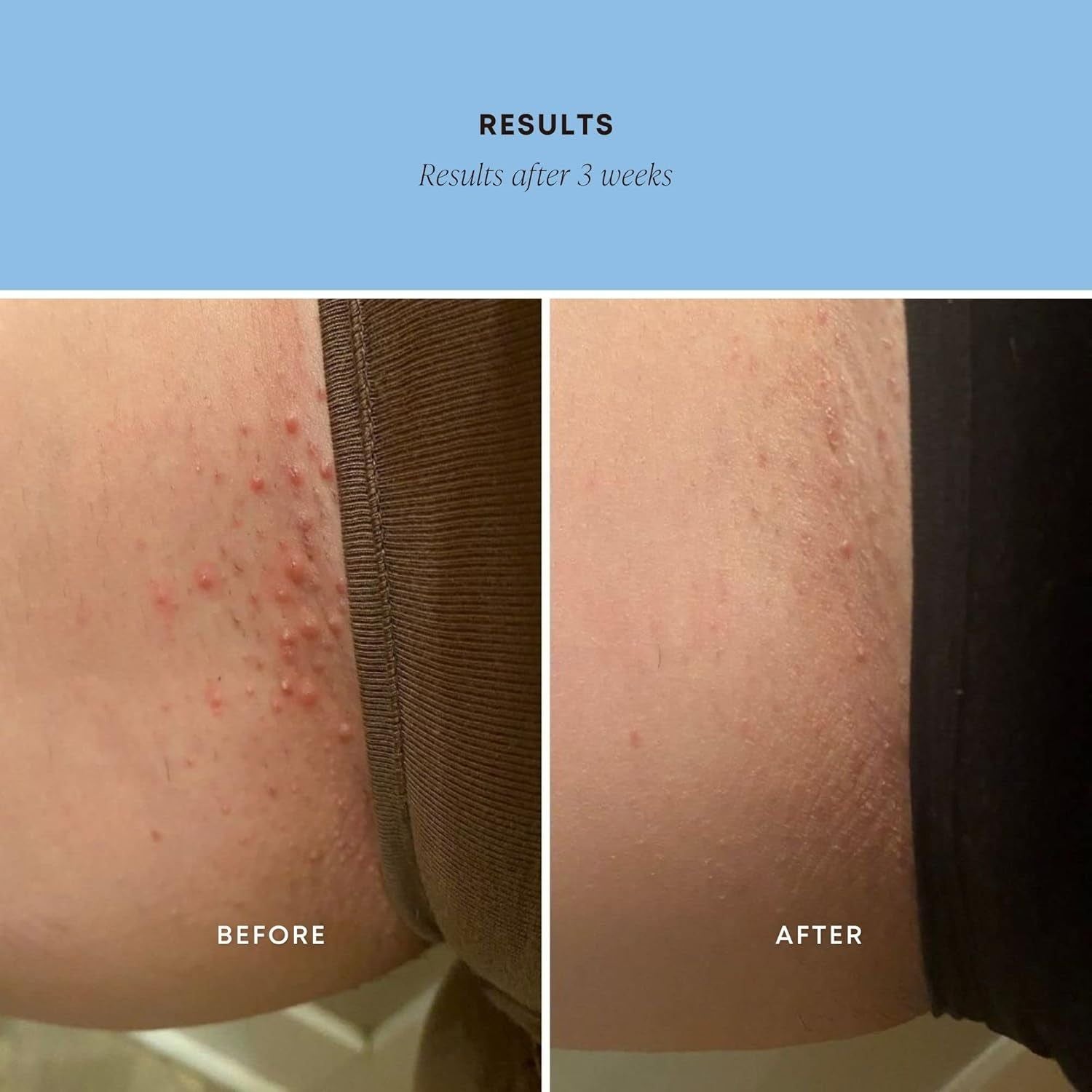 Bushbalm Ingrown Hair Exfoliating Scrub - Nude (236ml) | Smooth, Hydrated & Bump-Free Skin