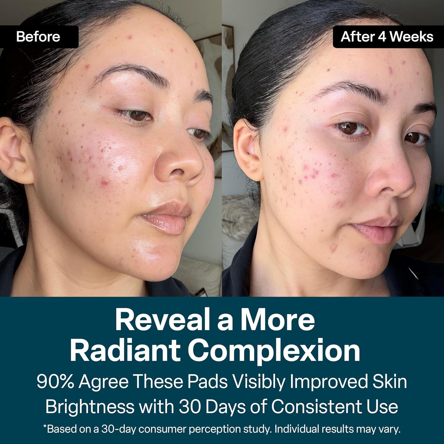Qrxlabs Glycolic Acid Pads - 20% Resurfacing Pads AHA for Face & Body - Exfoliates Skin Surface and Reduces Appearance of Fine Lines and Wrinkles - Acne Treatment Clearing - Daily Pads - 50Ct