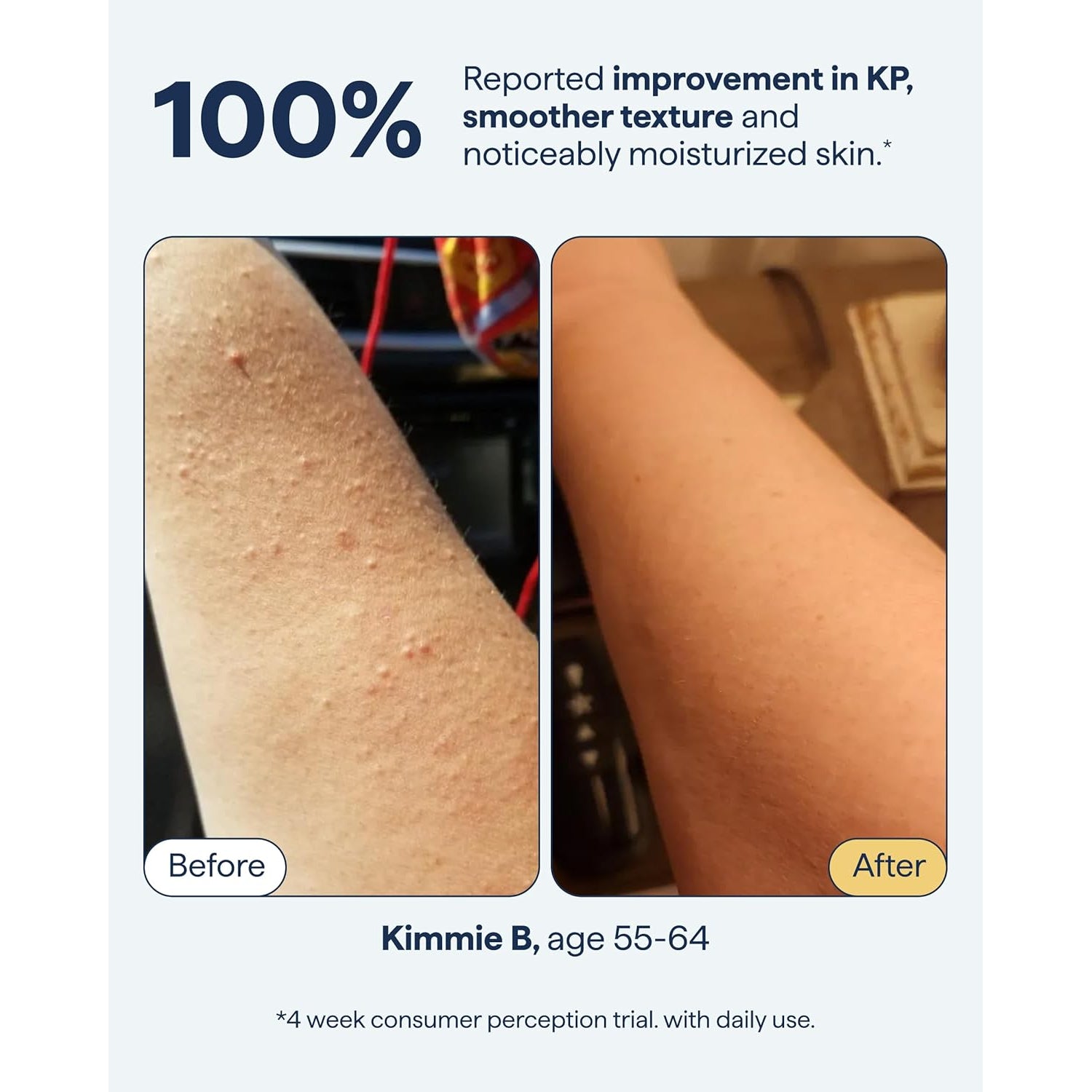 Remedy for Body Bumps KP Body Moisturizer - 225ml