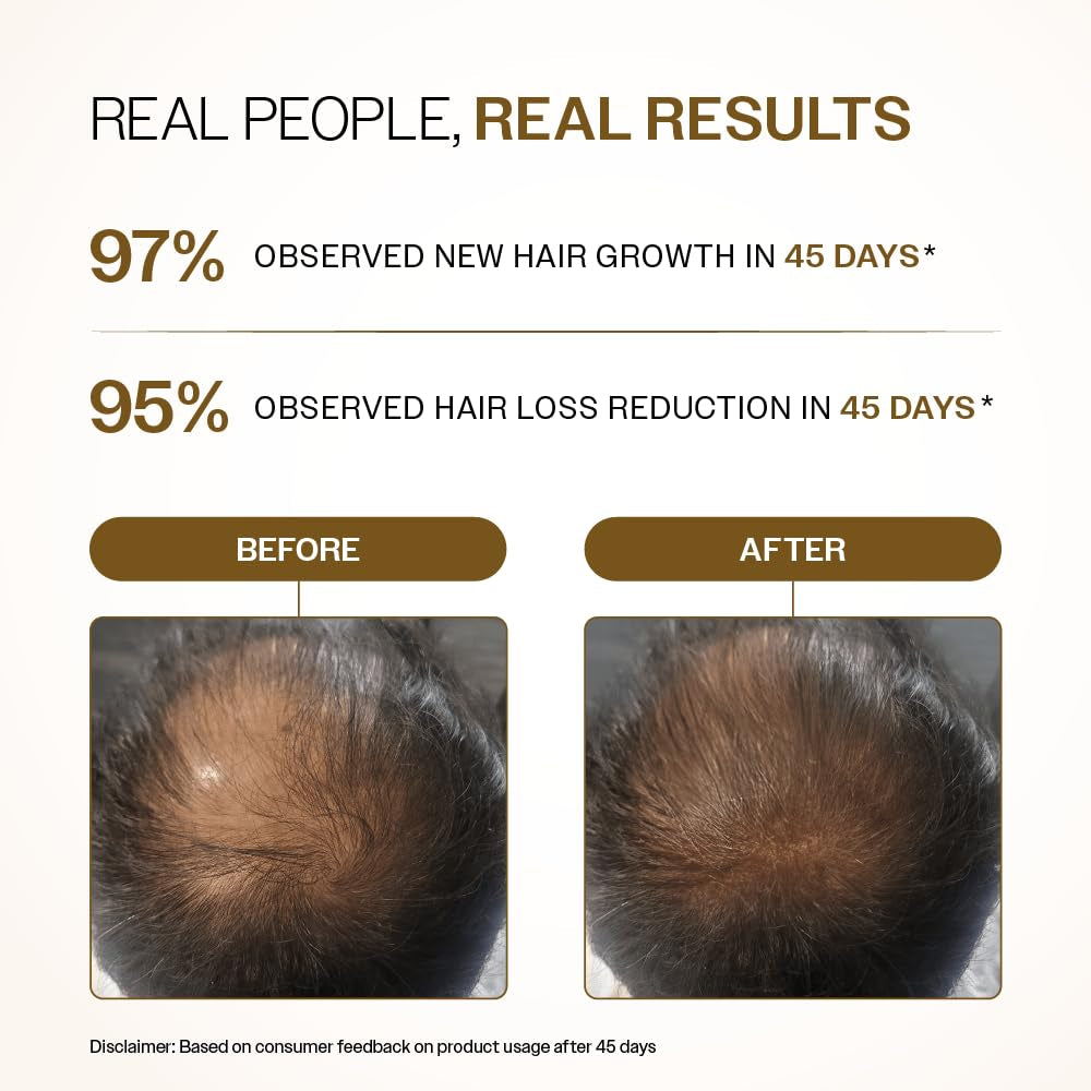 Bare Anatomy Advanced Hair Density Roll-On| 3% Redensyl + 4% Anagain + 2% Baicapil + 5% Rosemary, Rice Water, Biotin & Saw Palmetto| Reduces Hair Fall, Supports Hair Growth for Men & Women | 25Ml