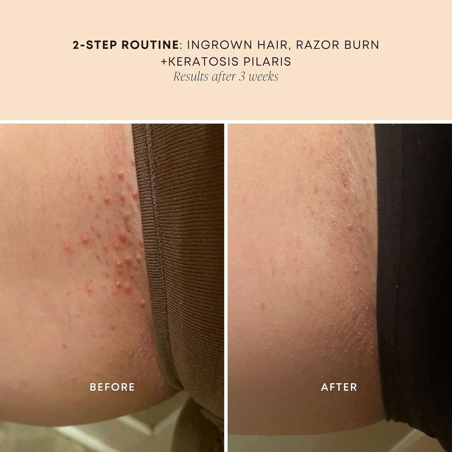 Bushbalm Ingrown Hair Oil (Sweet Escape) – 30ml | Soothing, Hydrating & Bump-Reducing Formula