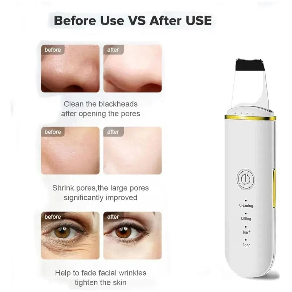 Beauty Ultrasonic Skin Scrubber - Glam Global UKGlam Global UK