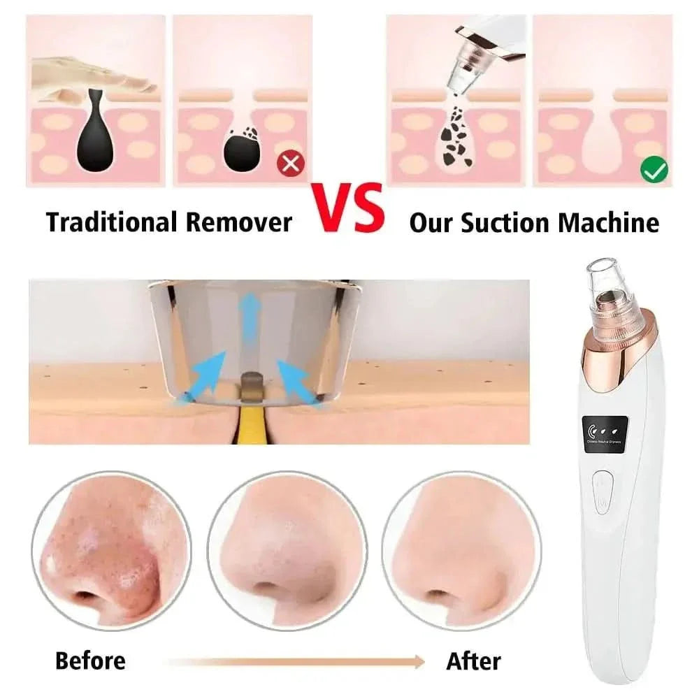Blackhead Remover Vacuum – Acne, Pimple & Black Spot Treatment - Glam Global UKGlam Global UK