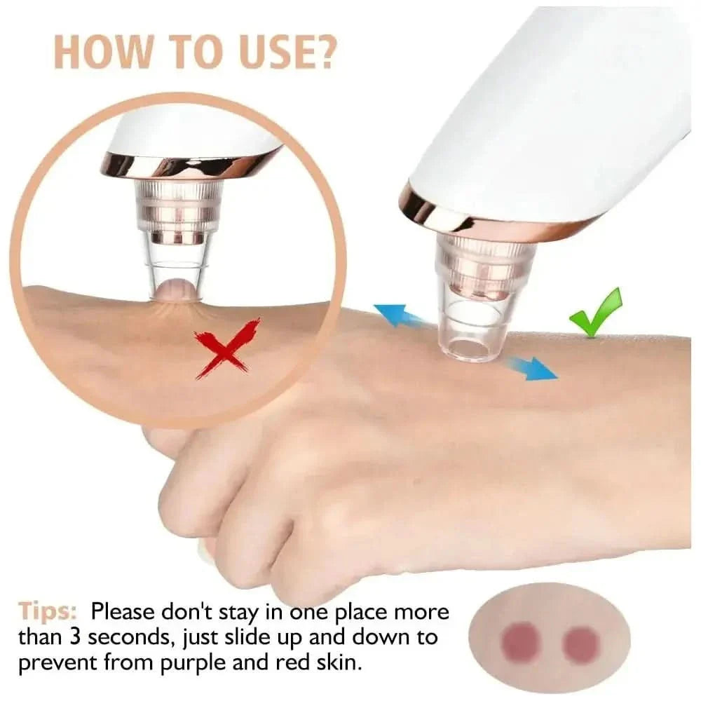 Blackhead Remover Vacuum – Acne, Pimple & Black Spot Treatment - Glam Global UKGlam Global UK