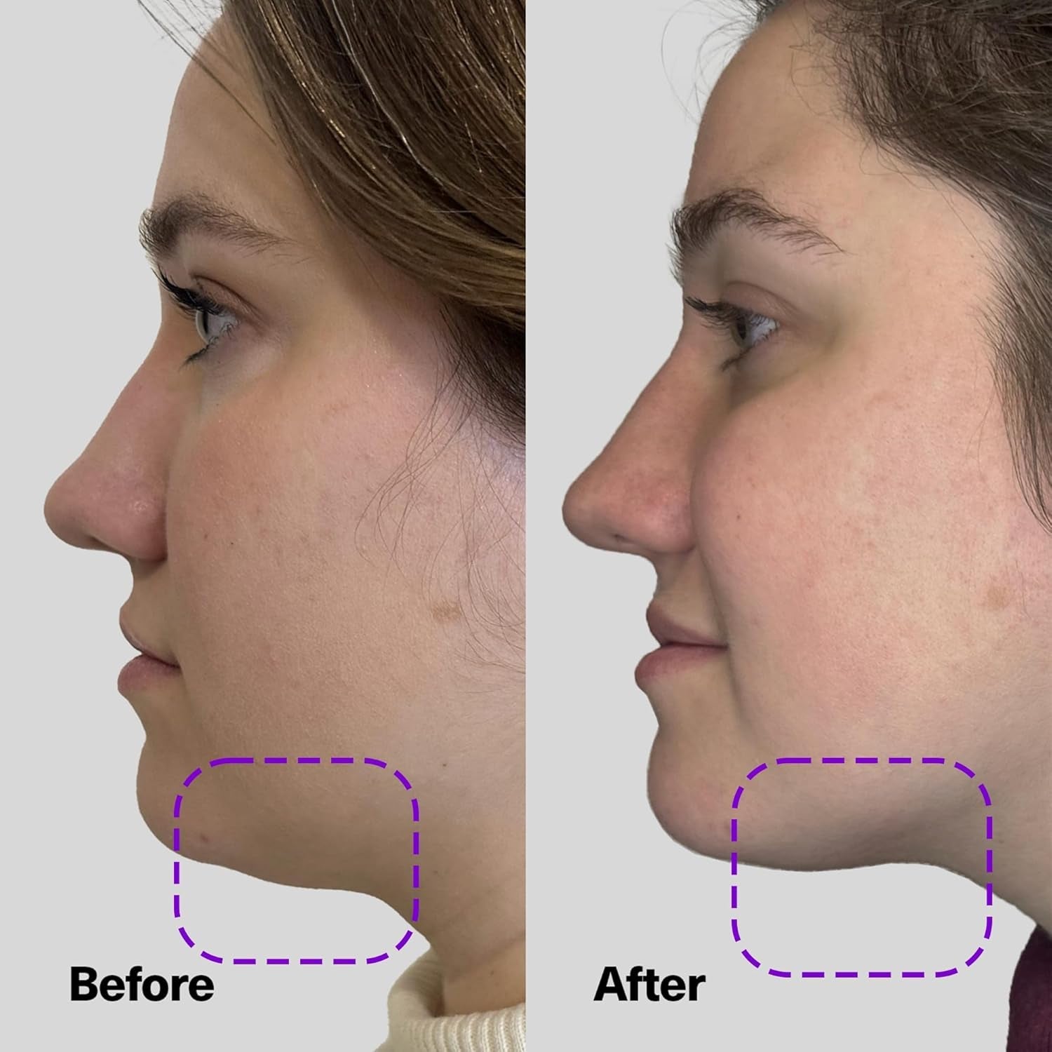 Shapeshift Advanced Jaw & Neck Firming Serum - Double Chin Reducer, Face Tightening Treatment with Exosome Technology to Lift Sagging Skin & Wrinkles in Both Women & Men, 1.7Oz