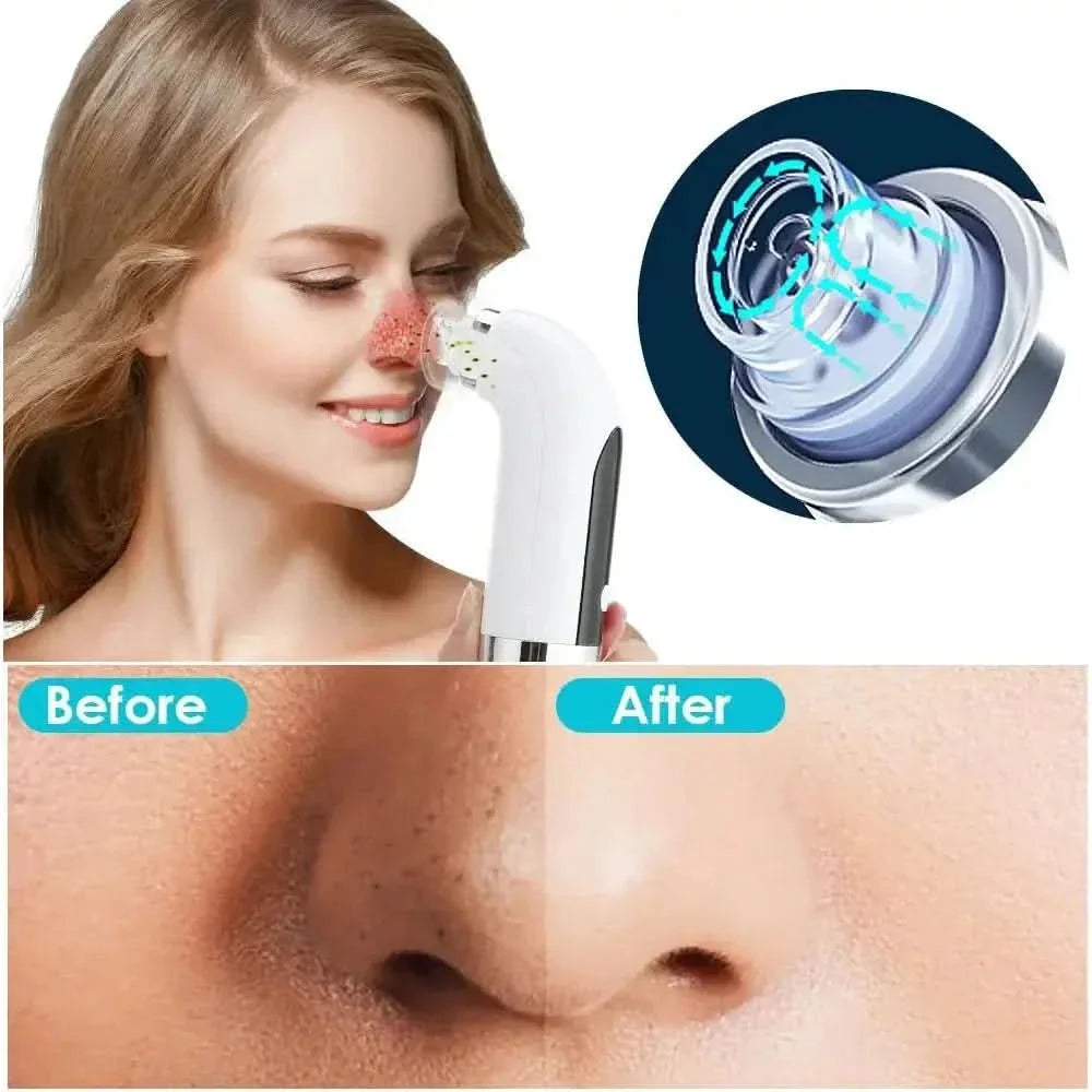 Electric Small Bubble Blackhead Remover – Reveal Clear, Radiant Skin - Glam Global UKGlam Global UK
