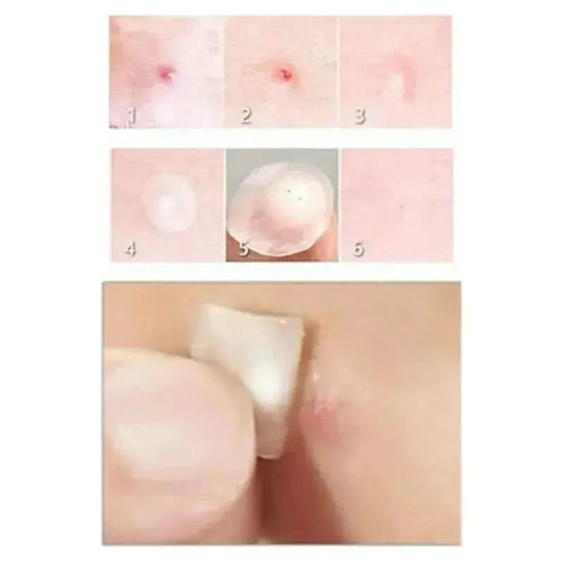 Face Acne Pimple Spot Scar Care Treatment Stickers - Glam Global UKGlam Global UK