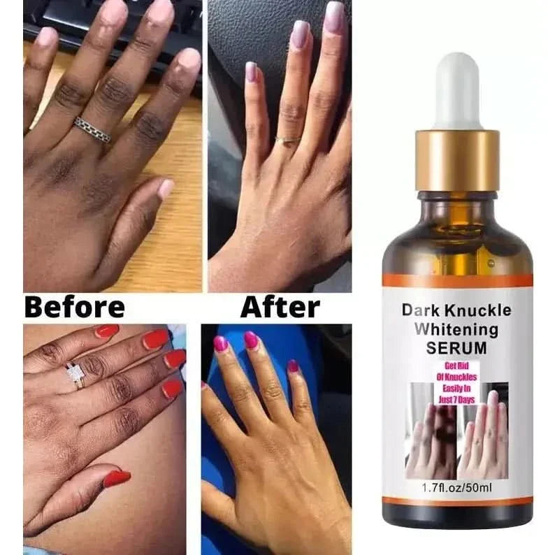 Intense Knuckle Whitening Serum: Unveil Radiant, Rejuvenated Hands - Glam Global UKGlam Global UK