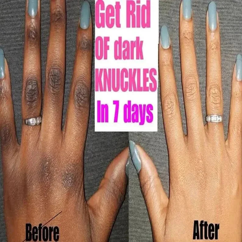 Intense Knuckle Whitening Serum: Unveil Radiant, Rejuvenated Hands - Glam Global UKGlam Global UK