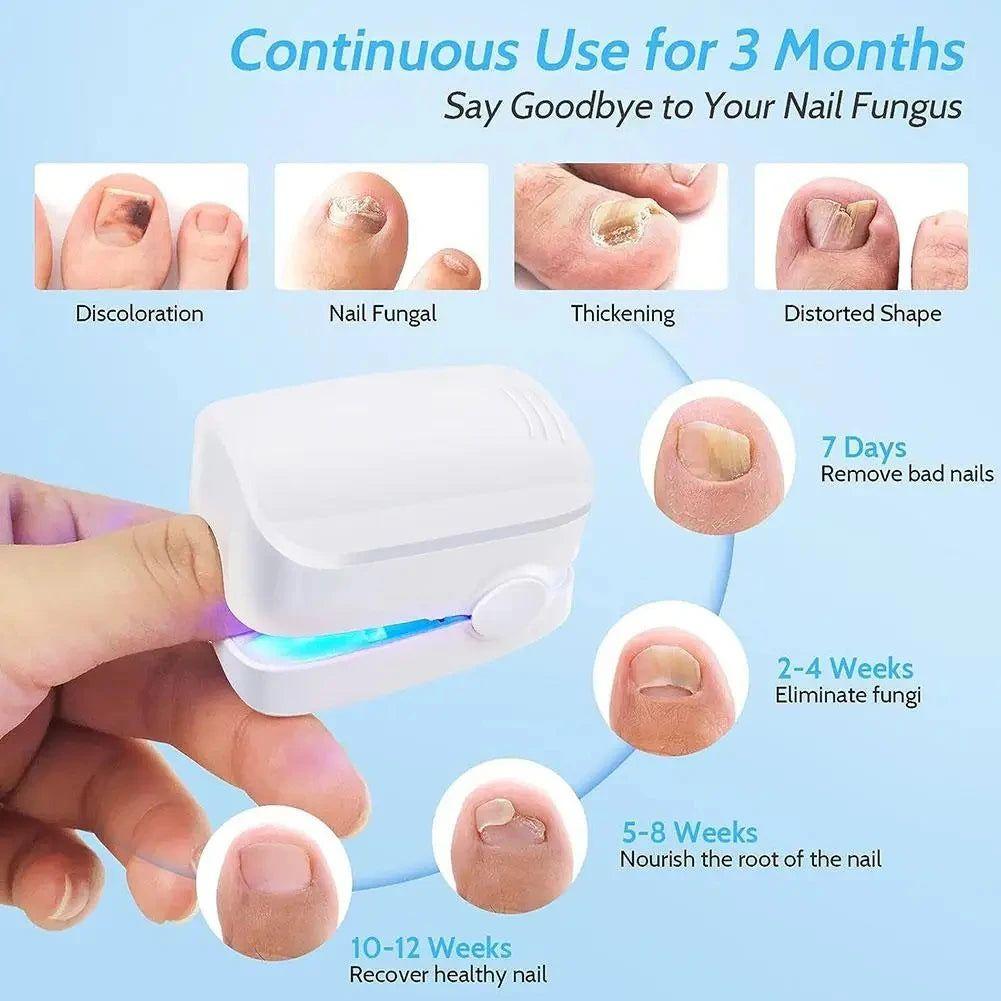 Laser Nail Fungus Treatment Device | Safe AND Effective Onychomycosis Therapy - Glam Global UKGlam Global UK