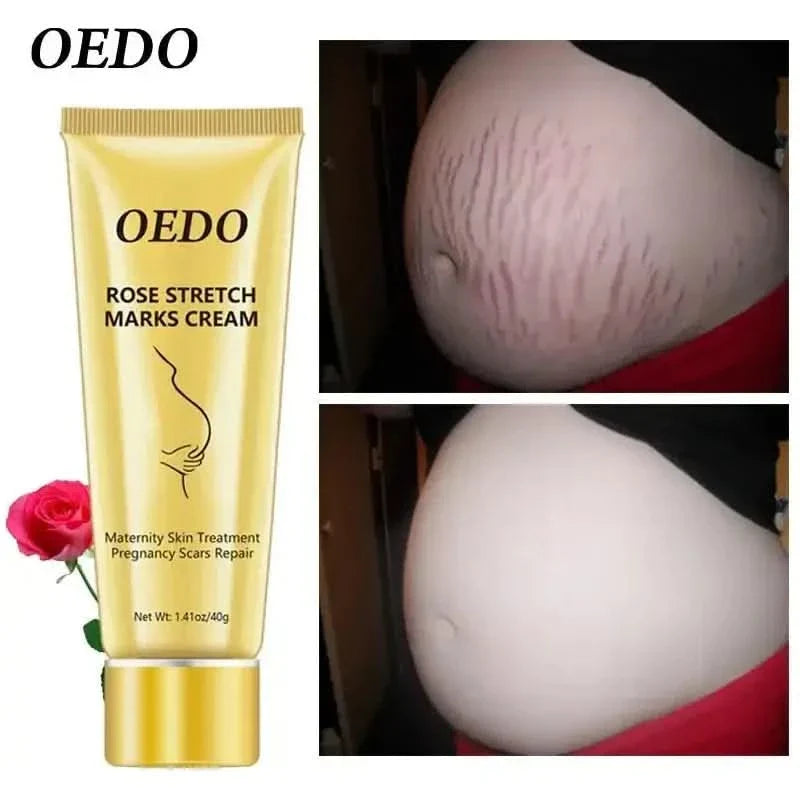 OEDO Stretch Mark Cream - Glam Global UKGlam Global UK
