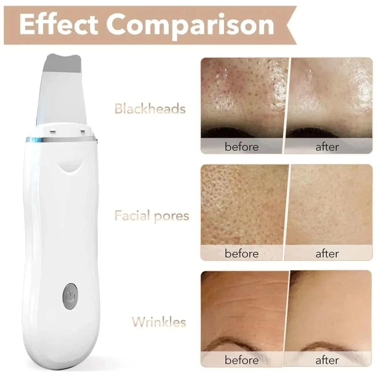 Ultrasonic Skin Scrubber – The Ultimate Solution for Radiant, Flawless Skin - Glam Global UKGlam Global UK
