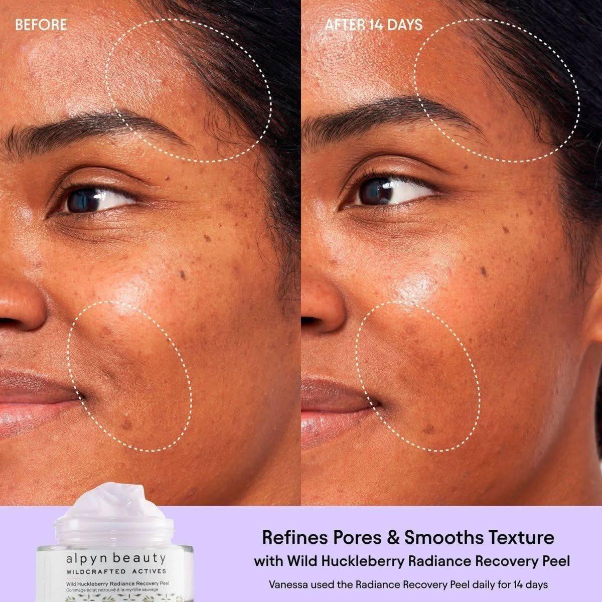 Alpyn Beauty Wild Huckleberry Radiance Recovery Peel - 50ml - Glam Global UKAlpyn Beauty