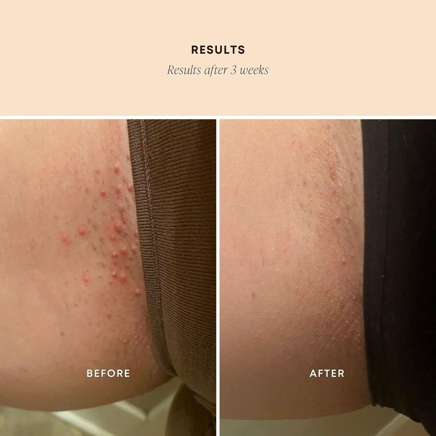 Bushbalm Ingrown Hair Exfoliating Scrub – Sweet Escape (236ml) | Soothing, Hydrating & Razor Bump Prevention