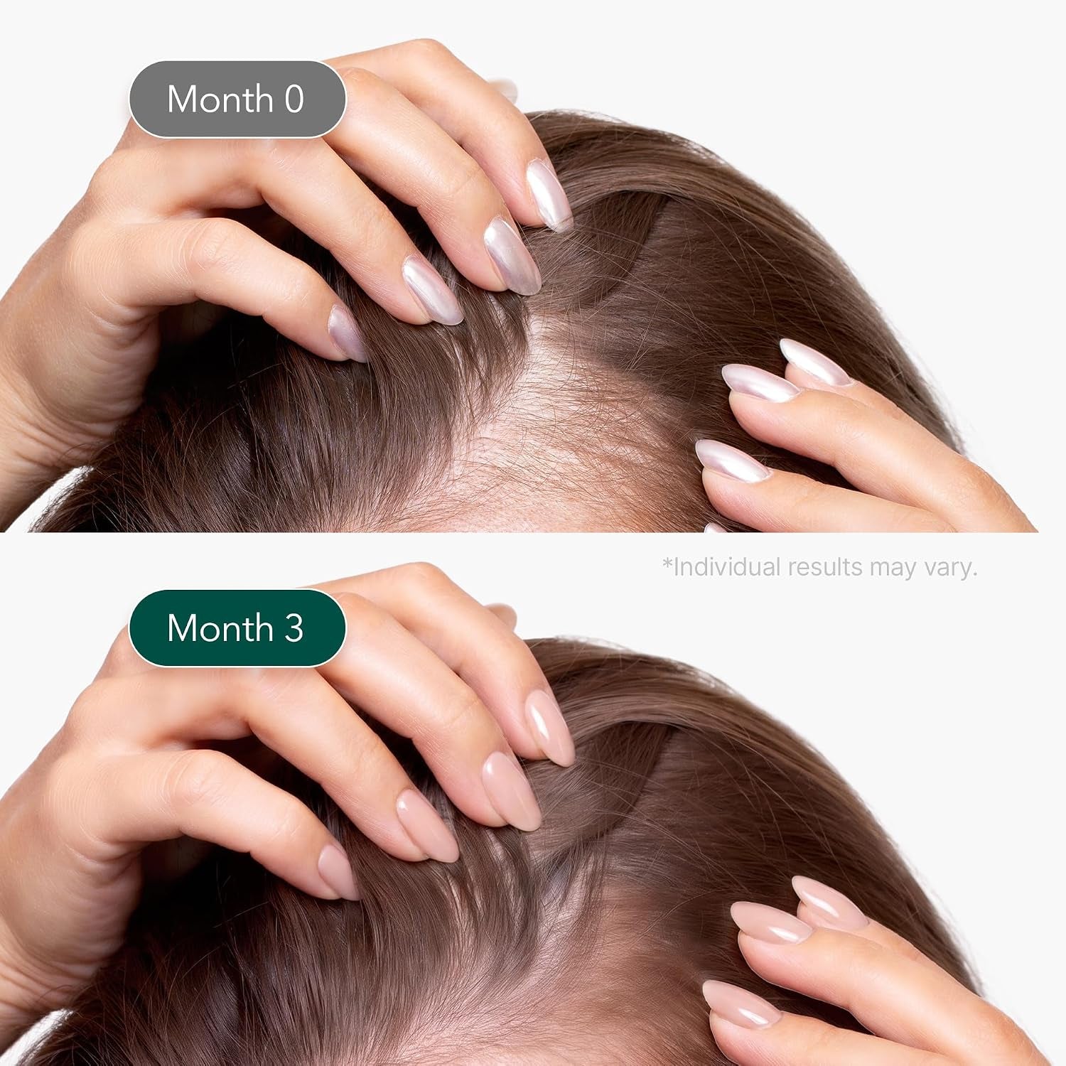 Vivelab Micro Foam Scalp Treatment - Hair Growth Serum for Thicker Hair, Premium Scalp Care with Biotin, Rosemary Oil & Caffeine, Clinically Tested Thinning Hair Care, Vegan