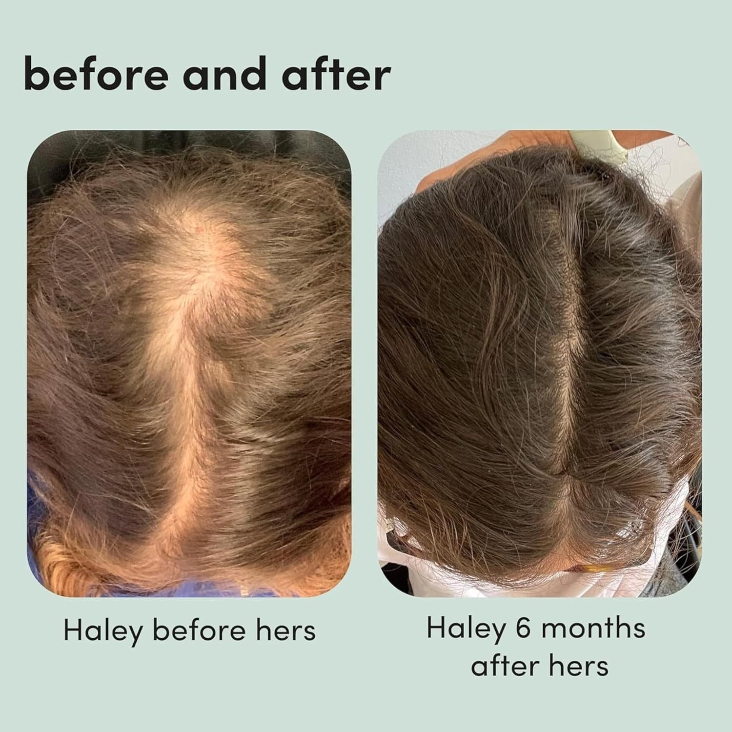 [HIMS & HERS] Hers Minoxidil Topical Solution USP, 2% – Hair Regrowth Treatment for Women (2 Pack, 60ml) | Clinically Proven to Restore Thinning Hair