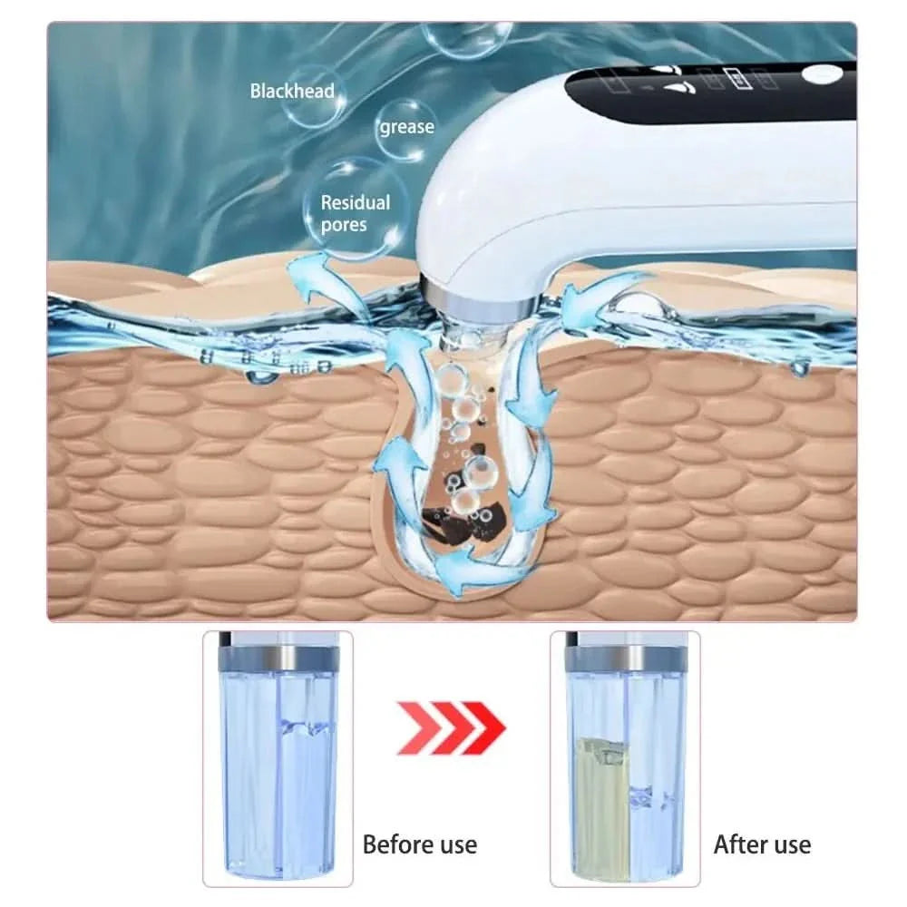 Blackhead Remover Device – Deep Cleansing and Hydration for Radiant Skin - Glam Global UKGlam Global UK