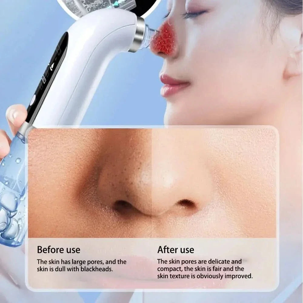 Blackhead Remover Device – Deep Cleansing and Hydration for Radiant Skin - Glam Global UKGlam Global UK
