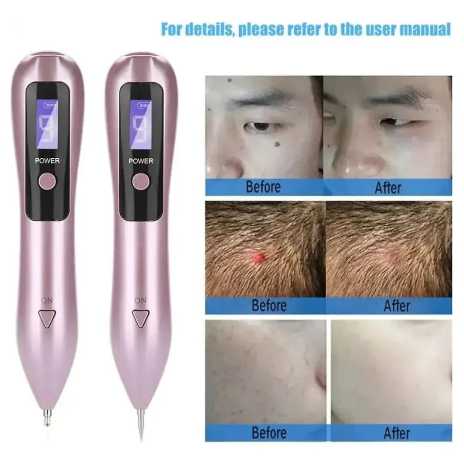 Dark Spot & Tattoo Remover Pen – Advanced Skin Spot Eraser with Precision Control - Glam Global UKGlam Global UK