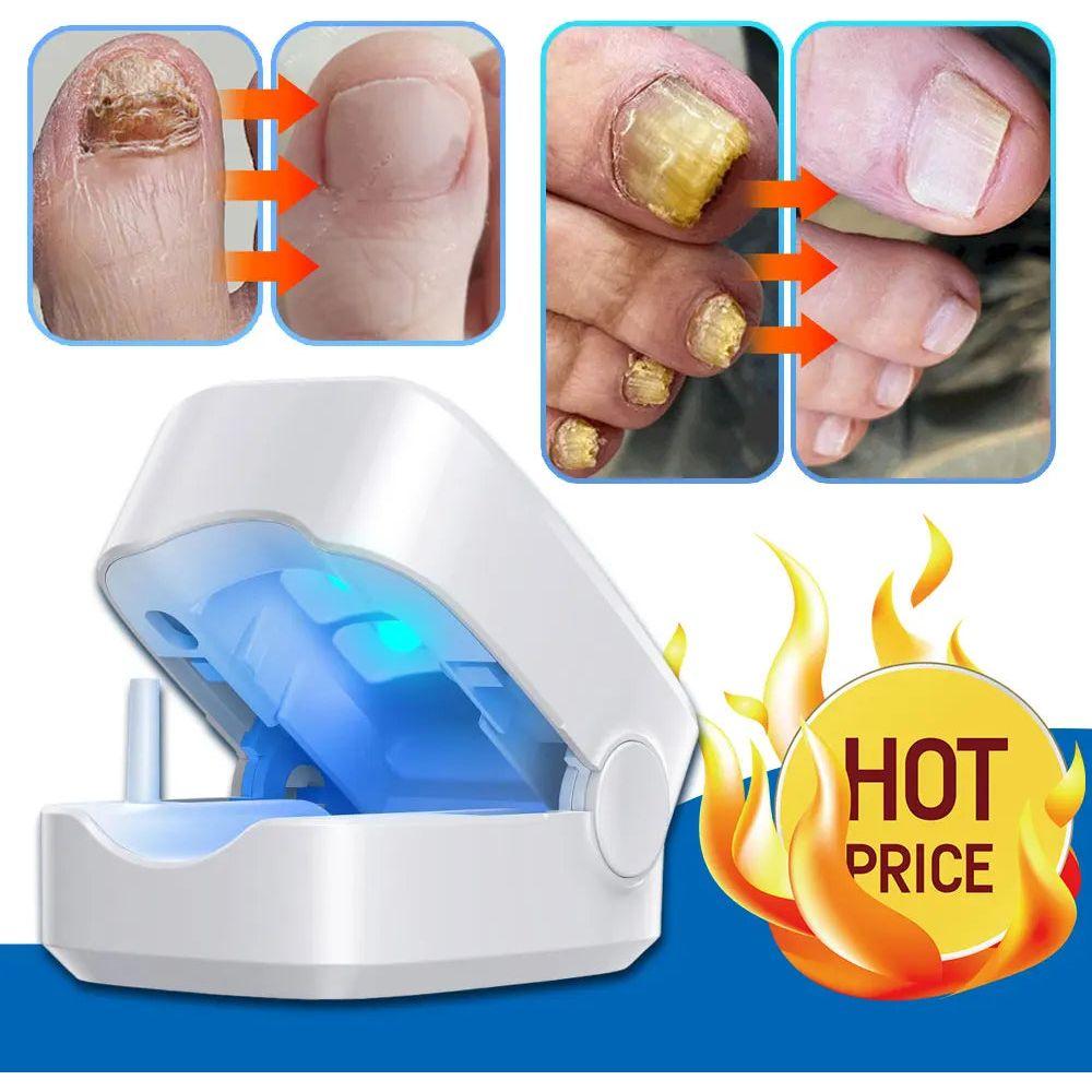 Laser Nail Fungus Treatment Device | Safe AND Effective Onychomycosis Therapy - Glam Global UKGlam Global UK
