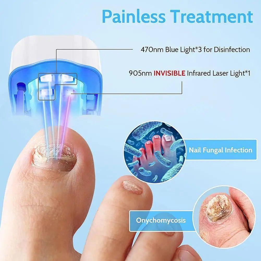 Laser Nail Fungus Treatment Device | Safe AND Effective Onychomycosis Therapy - Glam Global UKGlam Global UK