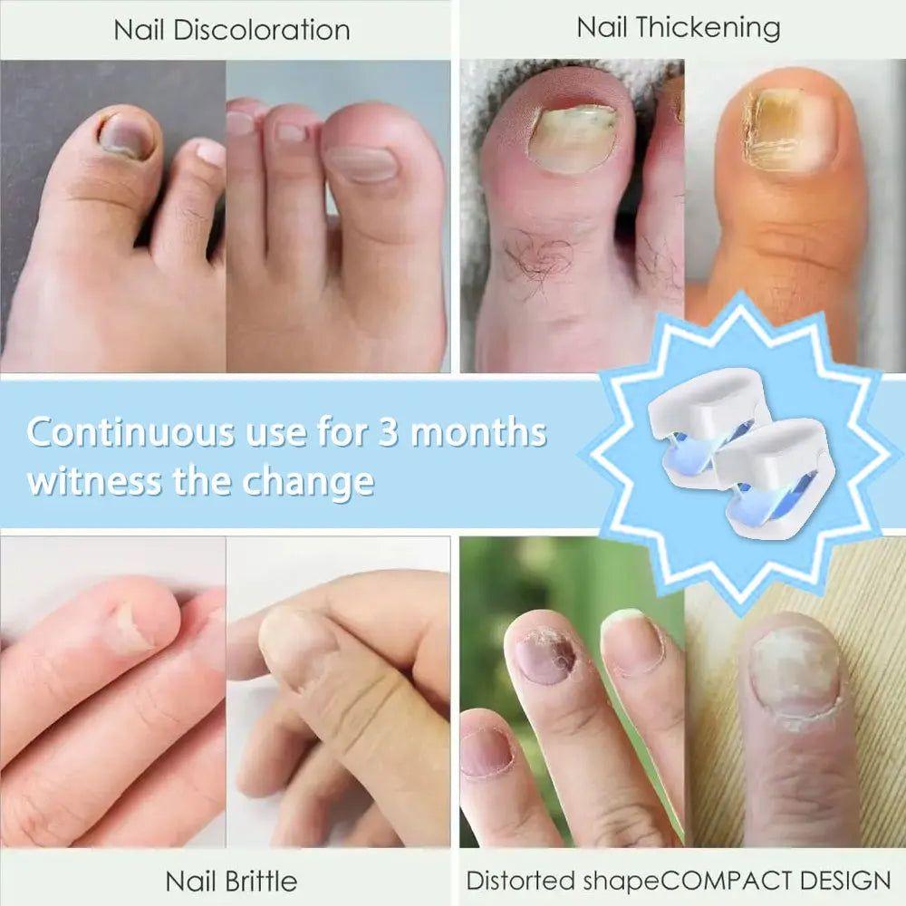 Laser Nail Fungus Treatment Device | Safe AND Effective Onychomycosis Therapy - Glam Global UKGlam Global UK