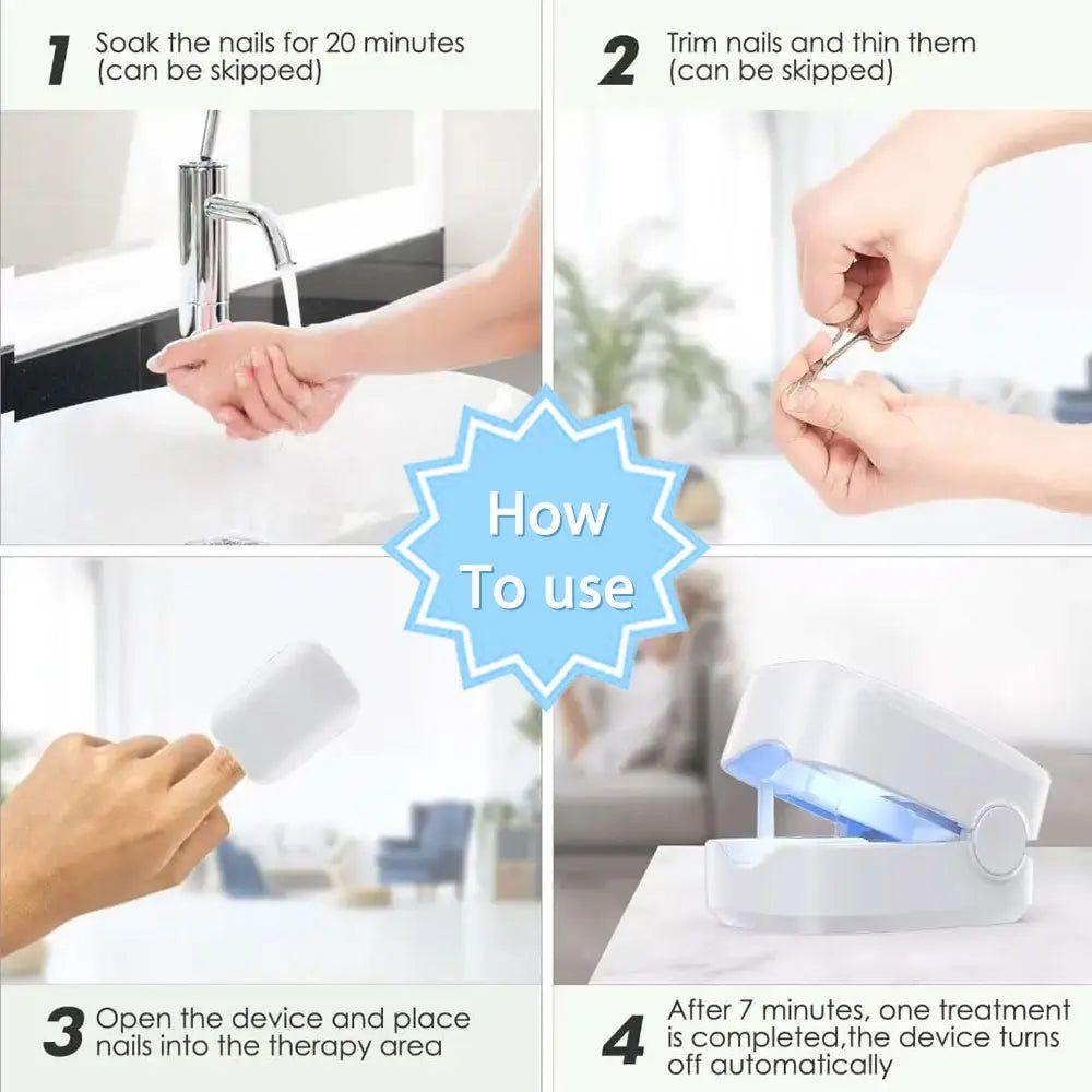Laser Nail Fungus Treatment Device | Safe AND Effective Onychomycosis Therapy - Glam Global UKGlam Global UK