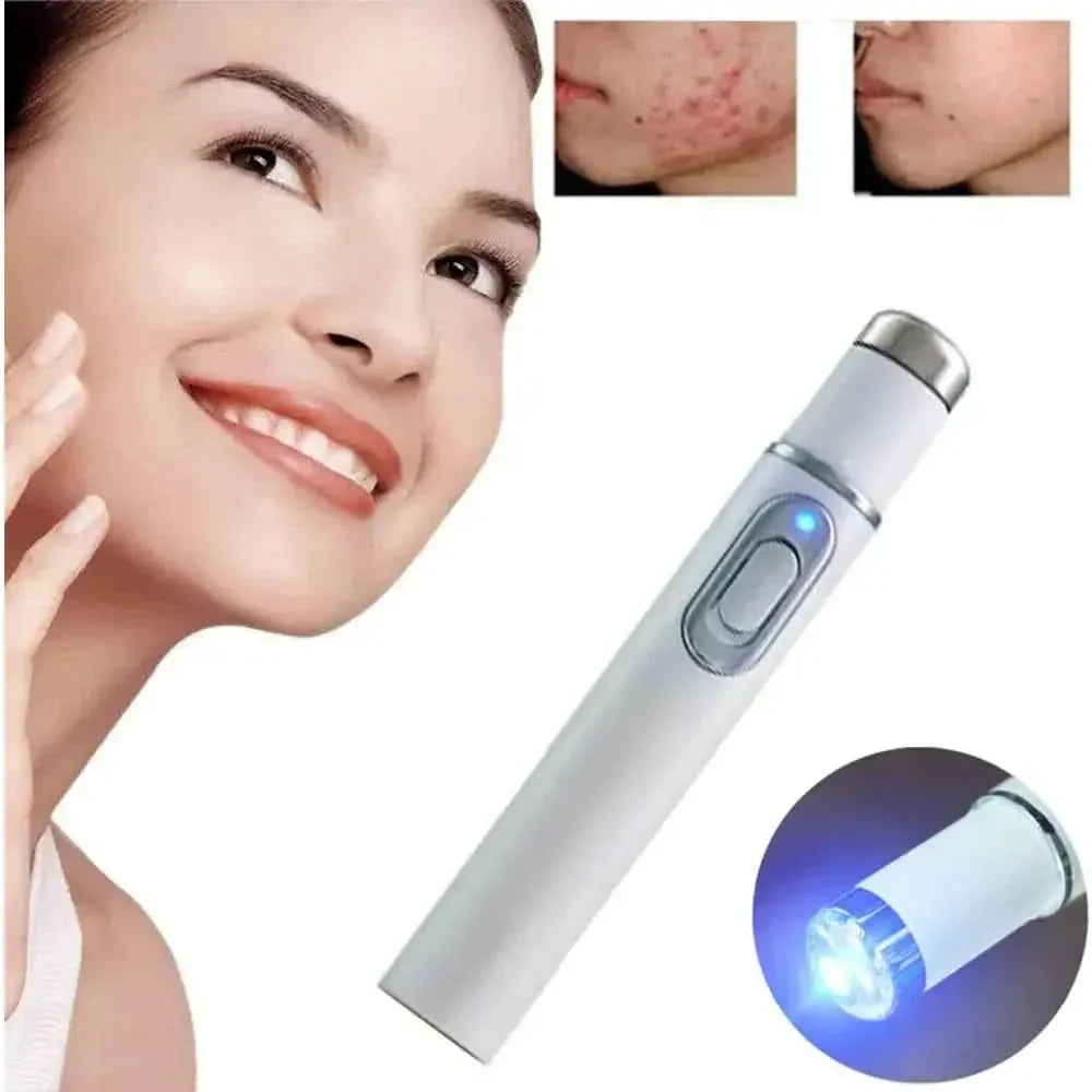 Light Therapy Acne Pen – Advanced LED Treatment for Clearer Skin - Glam Global UKGlam Global UK