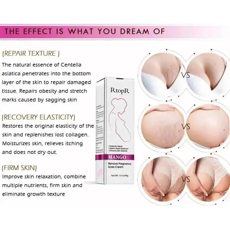 RtopR Mango Stretch Mark Cream For Pregnancy Repair - 40g - Glam Global UKRtopR