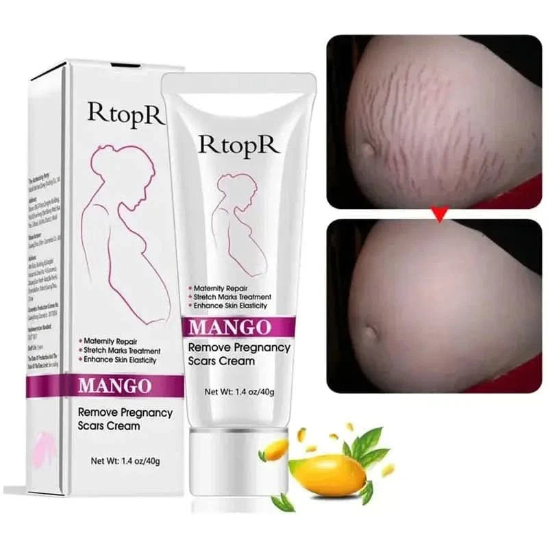 RtopR Mango Stretch Mark Cream For Pregnancy Repair - 40g - Glam Global UKRtopR