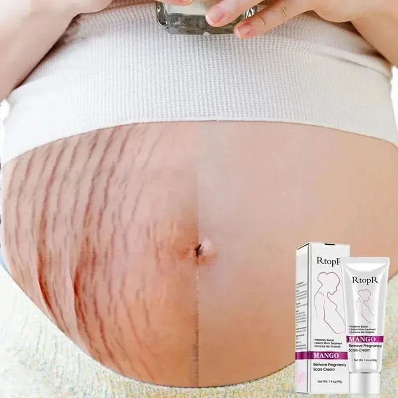 RtopR Mango Stretch Mark Cream For Pregnancy Repair - 40g - Glam Global UKRtopR