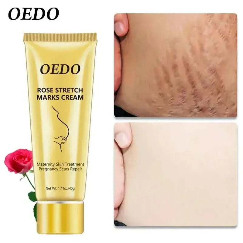 OEDO Stretch Mark Cream - Glam Global UKGlam Global UK
