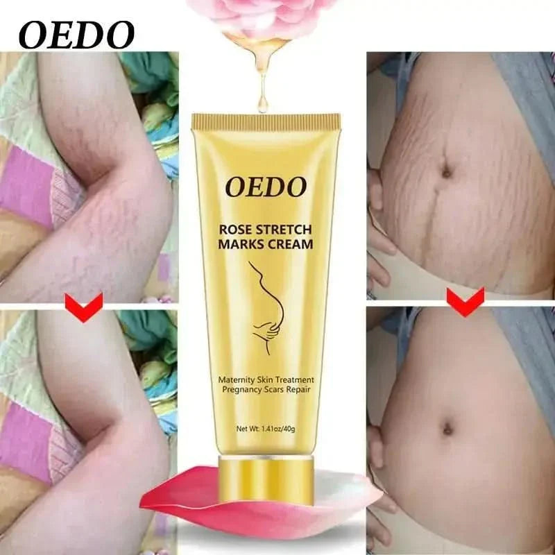 OEDO Stretch Mark Cream - Glam Global UKGlam Global UK