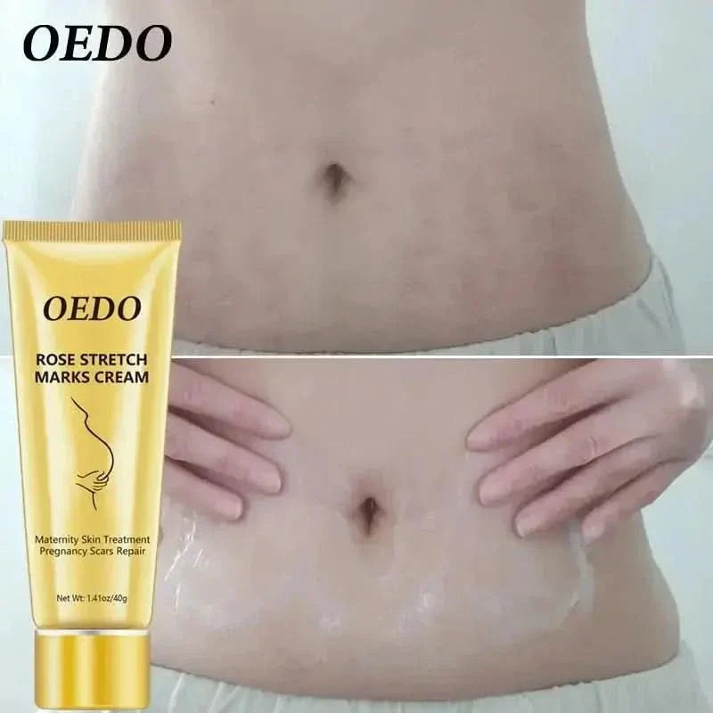 OEDO Stretch Mark Cream - Glam Global UKGlam Global UK