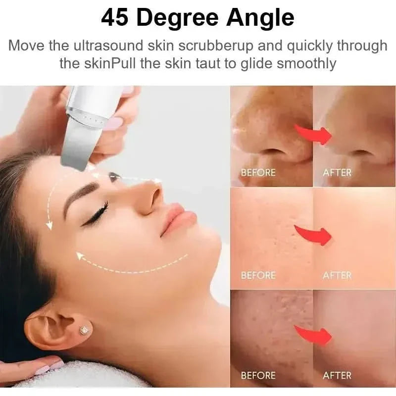 Skin Scrubber Blackhead Remover – Achieve Clear, Smooth Skin at Home - Glam Global UKGlam Global UK