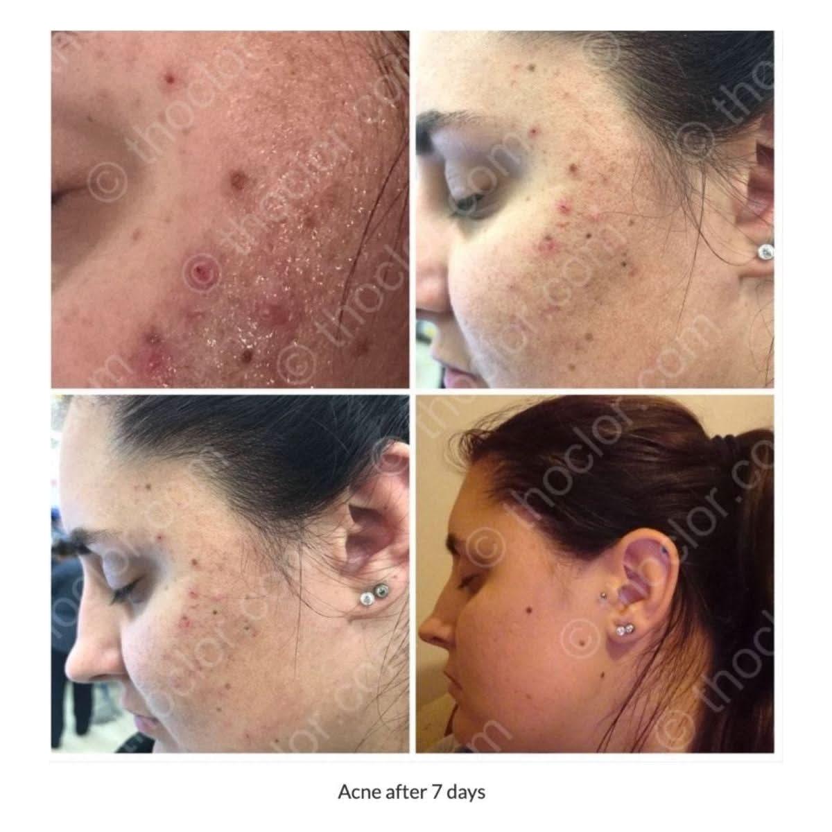 ThoClor Labs | GF2 Skin Rejuvenation - Glam Global UKThoclor Labs