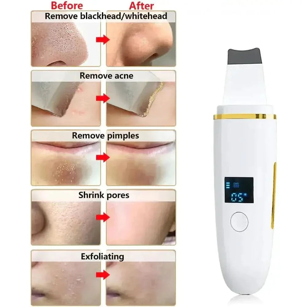 Ultrasonic Skin Scrubber: Professional Facial Cleansing Device - Glam Global UKGlam Global UK