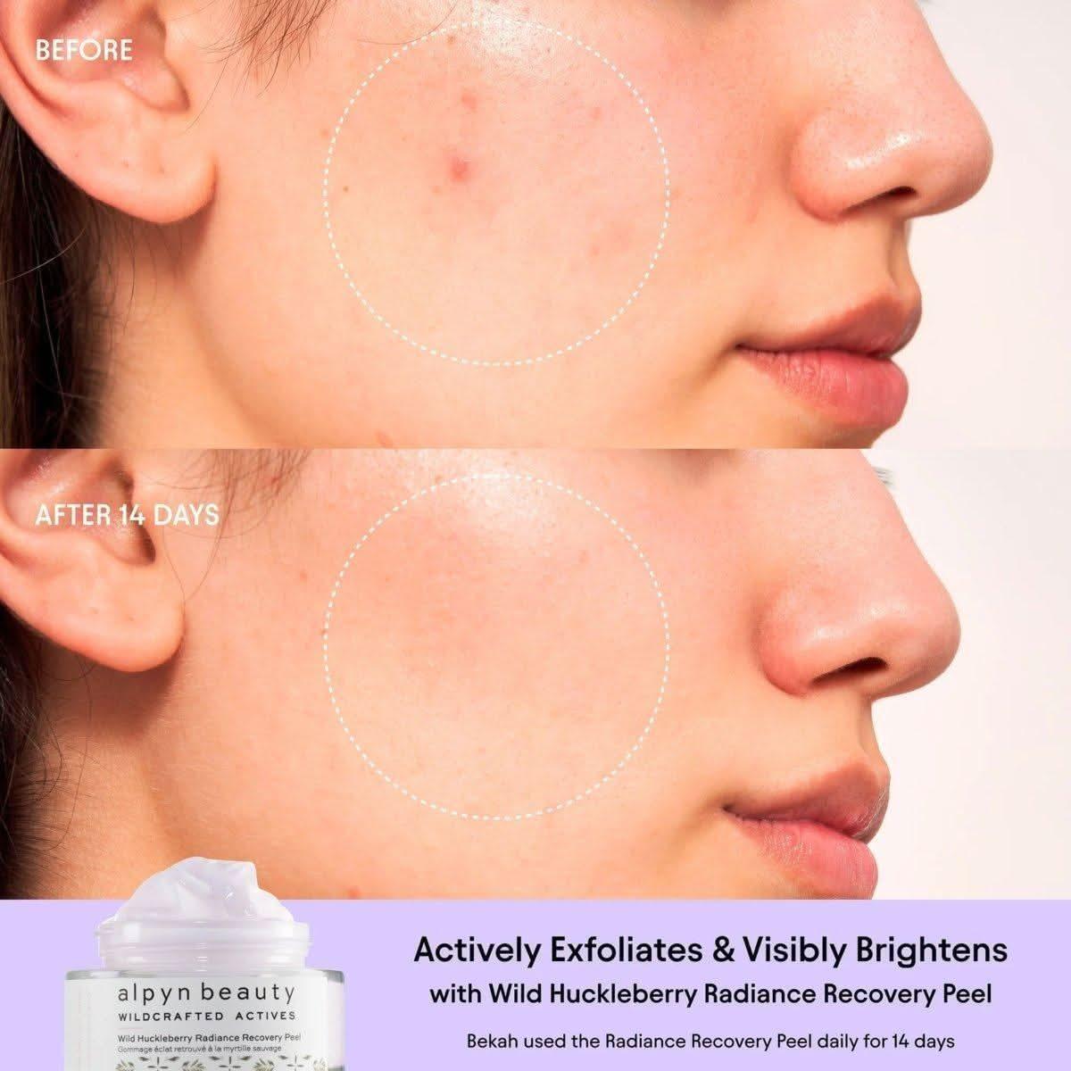 Alpyn Beauty Wild Huckleberry Radiance Recovery Peel - 50ml - Glam Global UKAlpyn Beauty